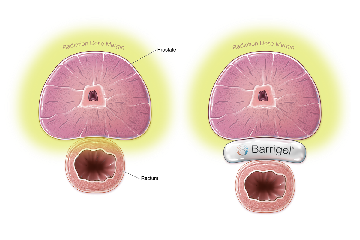 Barrigel® Rectal Spacing